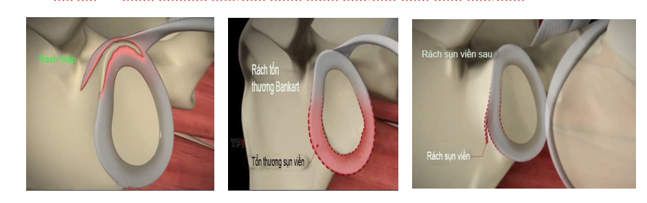 rach sun vien khop vai 3