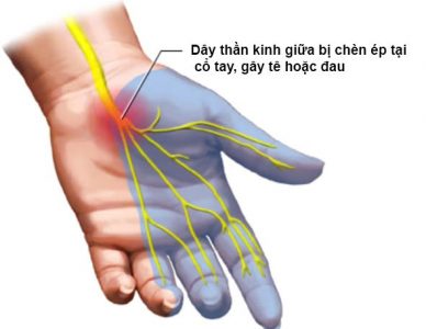 Hội chứng ống cổ tay