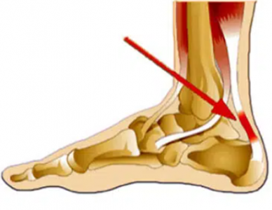 Rách đứt gân gót chân Achilles