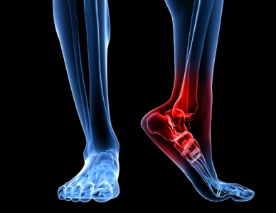 Viêm cân gan chân