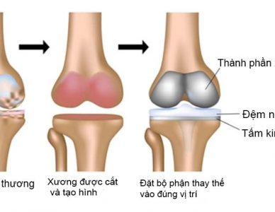 ĐAU ĐẦU GỐI – NGUYÊN NHÂN, TRIỆU CHỨNG VÀ CÁCH ĐIỀU TRỊ HIỆU QUẢ