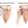 ĐÔNG CỨNG KHỚP VAI: HIỂU ĐÚNG ĐỂ ĐIỀU TRỊ ĐÚNG
