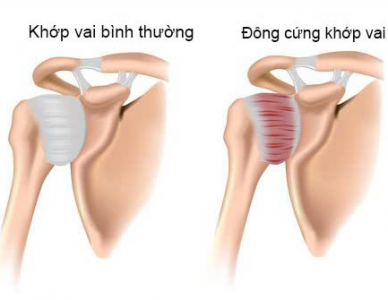 ĐÔNG CỨNG KHỚP VAI: HIỂU ĐÚNG ĐỂ ĐIỀU TRỊ ĐÚNG