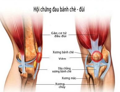 HỘI CHỨNG ĐAU BÁNH CHÈ ĐÙI