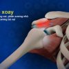 HỘI CHỨNG CHÈN ÉP VAI HOẶC VIÊM GÂN CHÓP XOAY: NGUYÊN NHÂN, TRIỆU CHỨNG VÀ ĐIỀU TRỊ