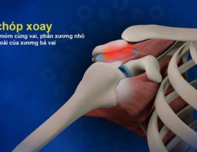 HỘI CHỨNG CHÈN ÉP VAI HOẶC VIÊM GÂN CHÓP XOAY: NGUYÊN NHÂN, TRIỆU CHỨNG VÀ ĐIỀU TRỊ