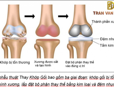 HƯỚNG DẪN TẬP LUYỆN VẬN ĐỘNG SAU PHẪU THUẬT THAY KHỚP GỐI