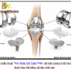 PHẪU THUẬT THAY KHỚP GỐI TOÀN PHẦN:  BÁC SĨ TRẦN VĂN DƯƠNG HƯỚNG DẪN TOÀN DIỆN TỪ KINH NGHIỆM HÀNG NGÀN CA THỰC TẾ PHẪU THUẬT THÀNH CÔNG