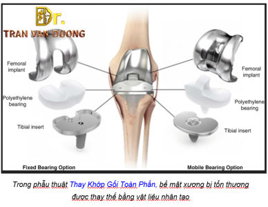 PHẪU THUẬT THAY KHỚP GỐI TOÀN PHẦN:  BÁC SĨ TRẦN VĂN DƯƠNG HƯỚNG DẪN TOÀN DIỆN TỪ KINH NGHIỆM HÀNG NGÀN CA THỰC TẾ PHẪU THUẬT THÀNH CÔNG