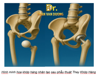 PHẪU THUẬT THAY KHỚP HÁNG TOÀN PHẦN:  HƯỚNG DẪN CHI TIẾT TỪ BÁC SĨ CHUYÊN KHOA 2 TRẦN VĂN DƯƠNG – CHUYÊN GIA VỚI KINH NGHIỆM TRONG HÀNG NGÀN CA LÂM SÀNG THÀNH CÔNG
