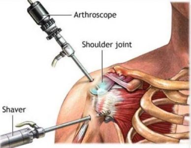 RÁCH CHÓP XOAY: NGUYÊN NHÂN, TRIỆU CHỨNG VÀ CÁCH ĐIỀU TRỊ