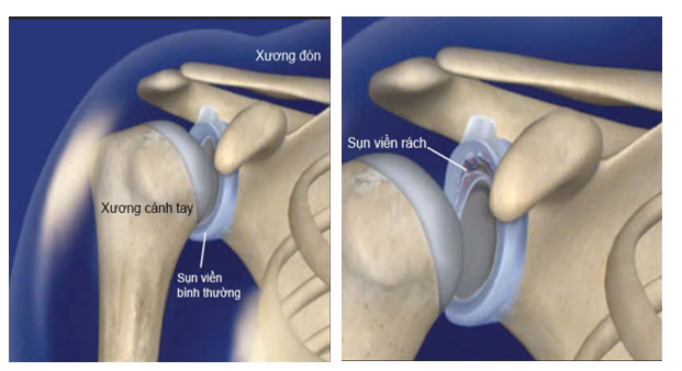 rach sun vien khop vai 4