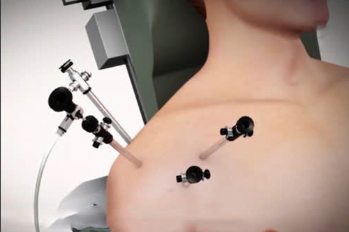 rach sun vien khop vai 5