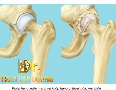 HƯỚNG DẪN TẬP LUYỆN VẬN ĐỘNG SAU PHẪU THUẬT THAY KHỚP HÁNG
