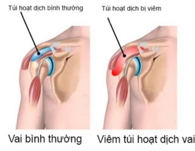 VIÊM BAO HOẠT DỊCH KHỚP VAI: NGUYÊN NHÂN, TRIỆU CHỨNG VÀ CÁCH ĐIỀU TRỊ HIỆU QUẢ