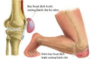 VIÊM BAO HOẠT DỊCH TRƯỚC XƯƠNG BÁNH CHÈ