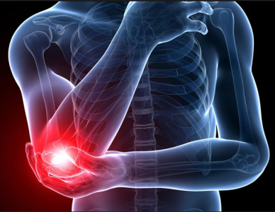 VIÊM MỎM LỒI CẦU NGOÀI XƯƠNG CÁNH TAY