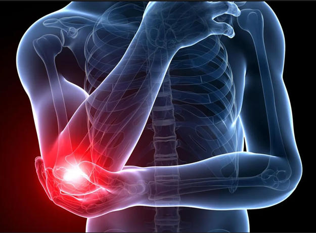 viêm lõm cầu ngoài 1